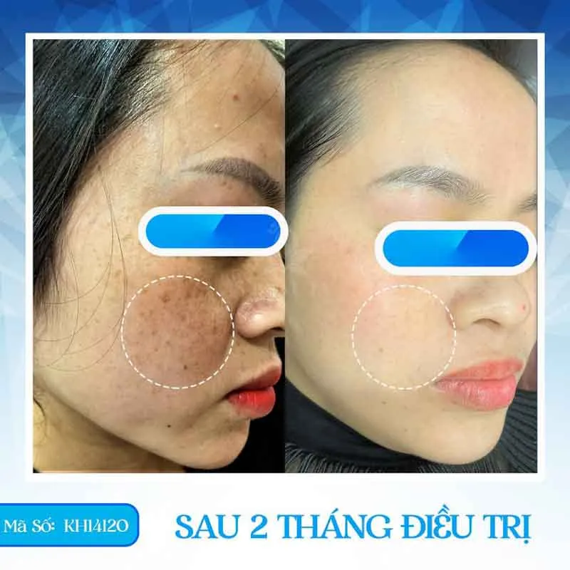 Bắn tia laser trị tàn nhang có tốt không? Bắn laser cần kiêng gì