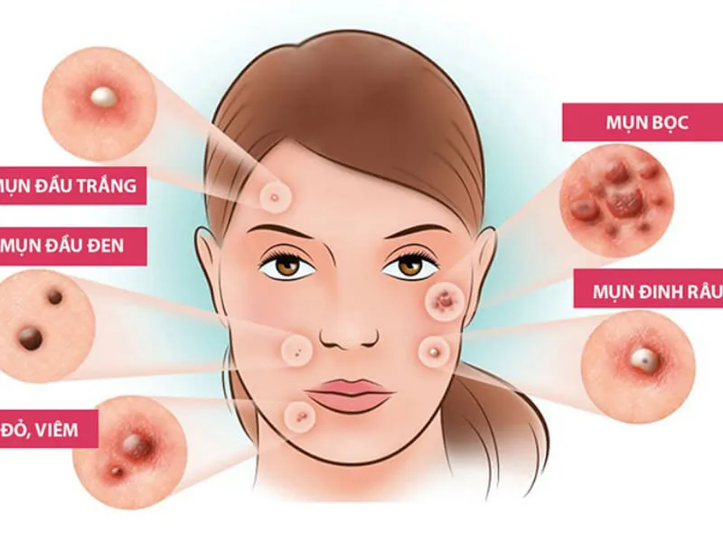 Bật mí các bước nặn mụn chuẩn y khoa an toàn hạn chế thâm sẹo