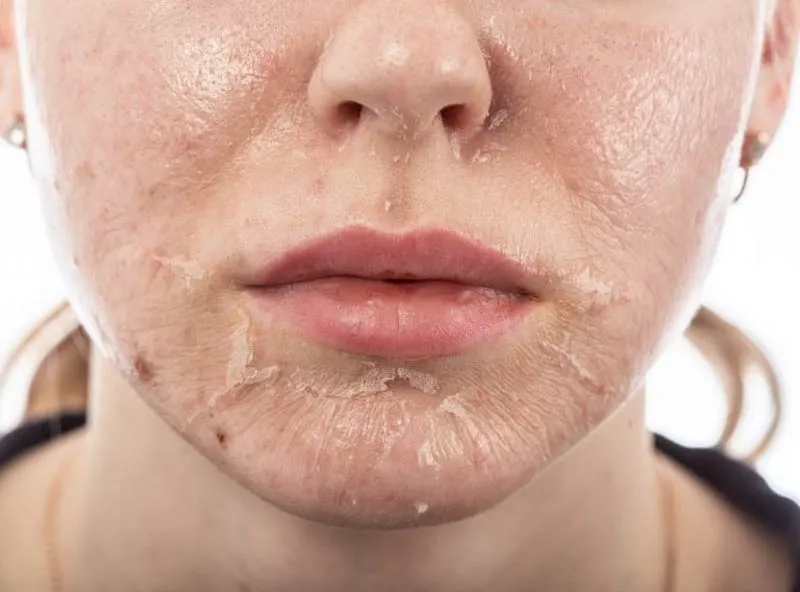 Bật mí các bước skincare sau khi peel da đúng cách và hiệu quả