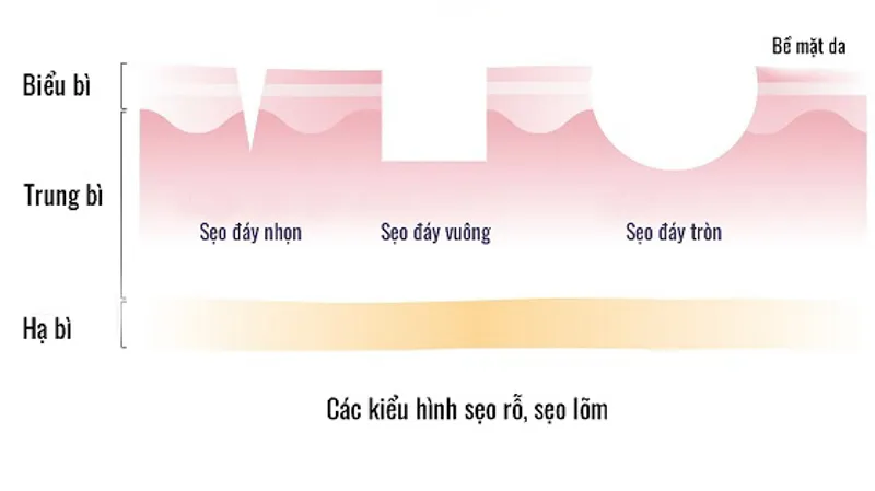 Bí kíp chấm TCA trị sẹo rỗ giúp da có được hiệu quả tốt nhất