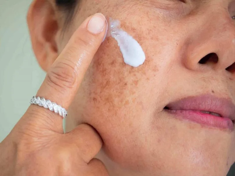 Bớt Hori (Hori Nevus) là gì? Nám Hori có chữa được không?