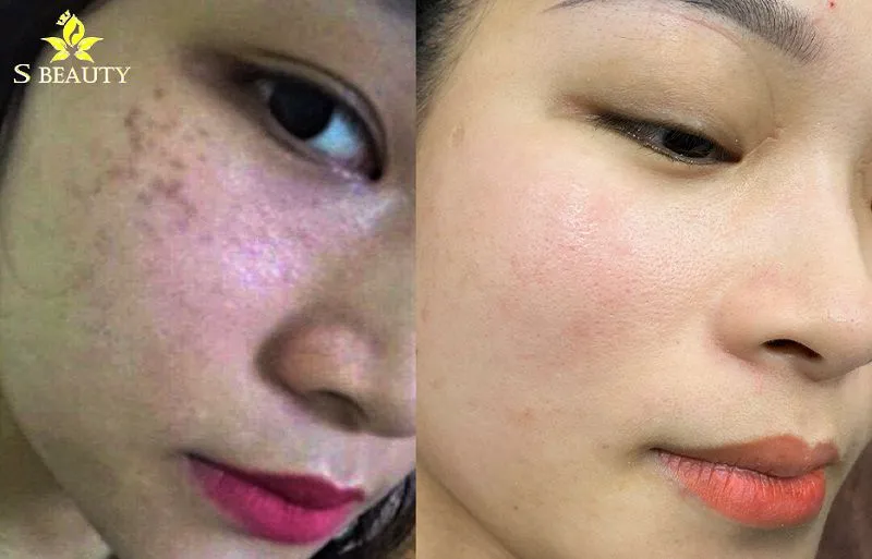 Bớt Hori (Hori Nevus) là gì? Nám Hori có chữa được không?