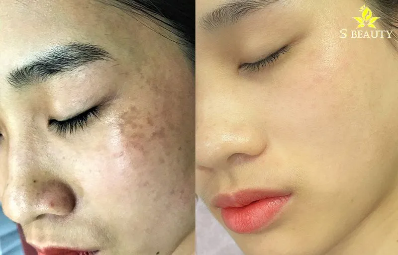 Bớt Hori (Hori Nevus) là gì? Nám Hori có chữa được không?