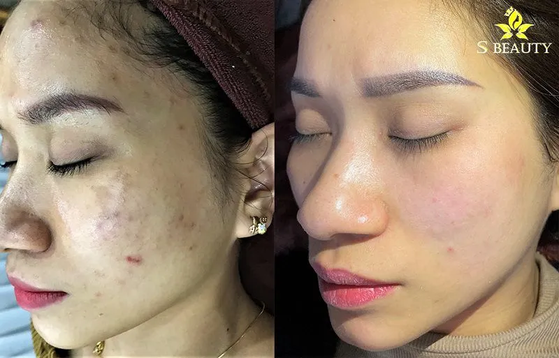 Bớt Hori (Hori Nevus) là gì? Nám Hori có chữa được không?