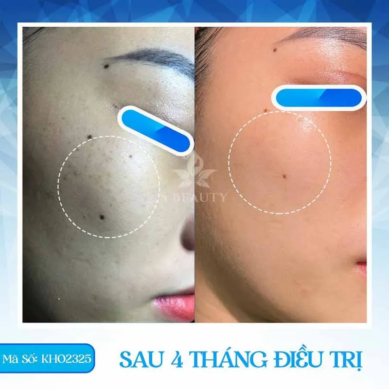 Các bước chăm sóc da sau khi bắn laser trị tàn nhang chuẩn khoa học