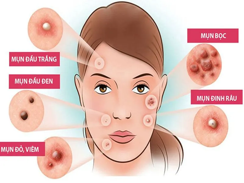 Cách ngăn ngừa mụn mà bạn nên biết nếu muốn có làn da đẹp