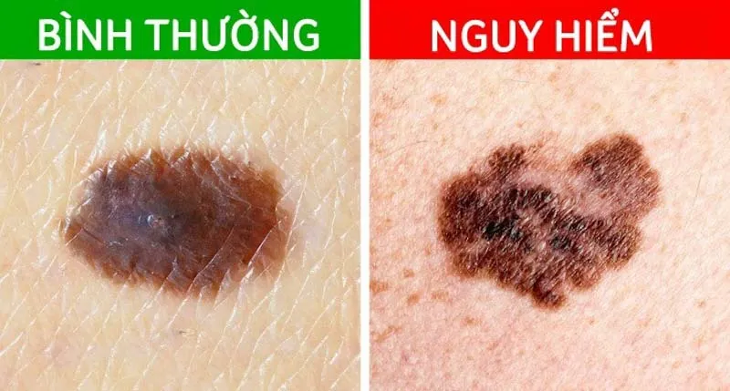 Cách nhận biết nốt ruồi ác tính? Hiện tượng như nào thì nên gặp bác sĩ