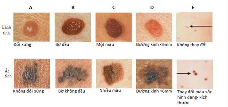 Cách nhận biết nốt ruồi ác tính? Hiện tượng như nào thì nên gặp bác sĩ