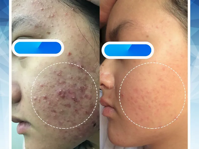 "Đánh bay" mụn viêm ở má tại Phòng khám SBeauty