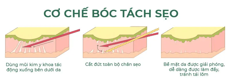 Cắt đáy sẹo bao lâu thì hết? Bóc tách đáy sẹo có đau không?