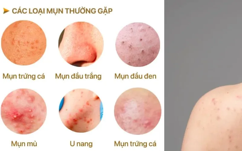 Có nên nặn mụn lưng không? Tạm biệt mụn lưng với 4 bước đơn giản 