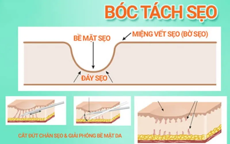 Dấu hiệu nhận biết các loại sẹo rỗ và phương pháp điều trị hiệu quả