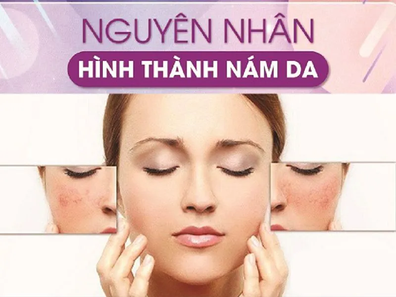 Điều trị nám tận gốc hiệu quả cao tại phòng khám chuẩn y khoa