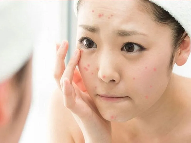 Kinh nghiệm trị mụn bằng Isotretinoin an toàn cho người mới