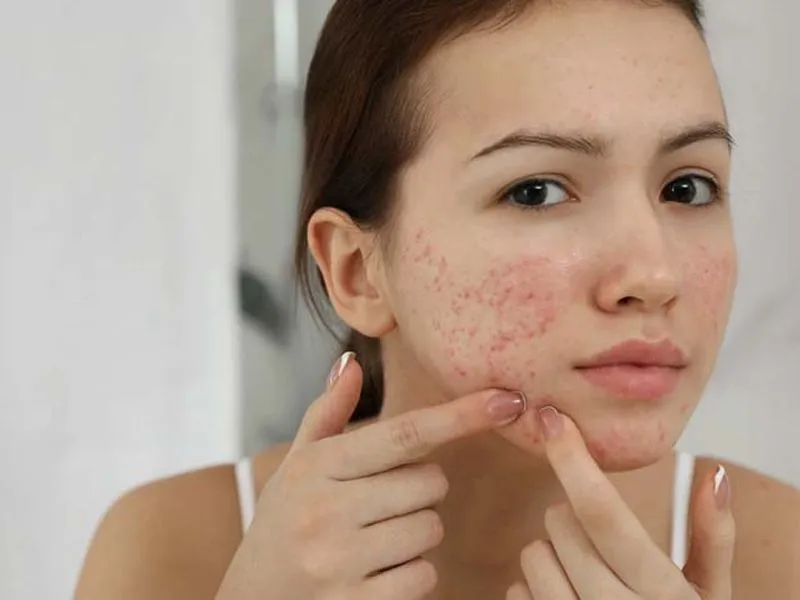 Kinh nghiệm trị mụn bằng Isotretinoin an toàn cho người mới