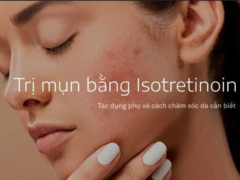 Kinh nghiệm trị mụn bằng Isotretinoin an toàn cho người mới