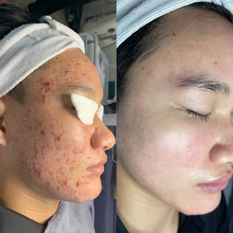 Laser Gold Toning – Giải pháp trị thâm đỏ, làm trẻ hóa da hiệu quả