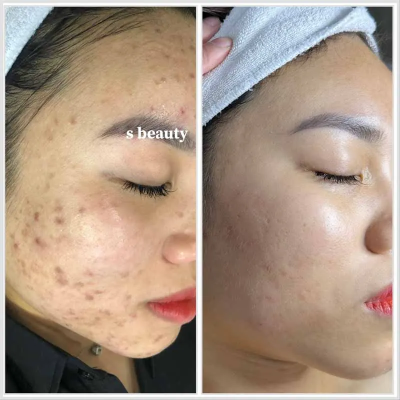 Laser Gold Toning – Giải pháp trị thâm đỏ, làm trẻ hóa da hiệu quả