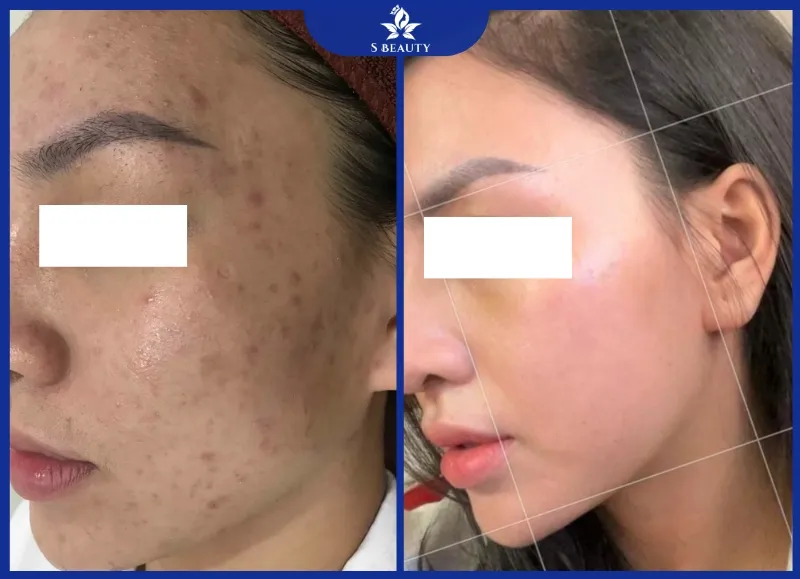 Lý do khiến S Beauty trở thành phòng khám trị mụn uy tín hàng đầu cả nước