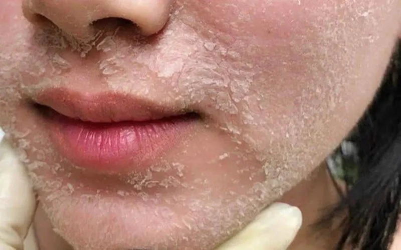 Những tác hại của việc peel da. Những người không nên peel da