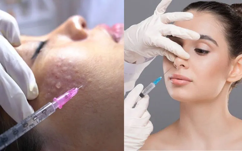 [Phân biệt] Tiêm meso và filler khác nhau như thế nào?