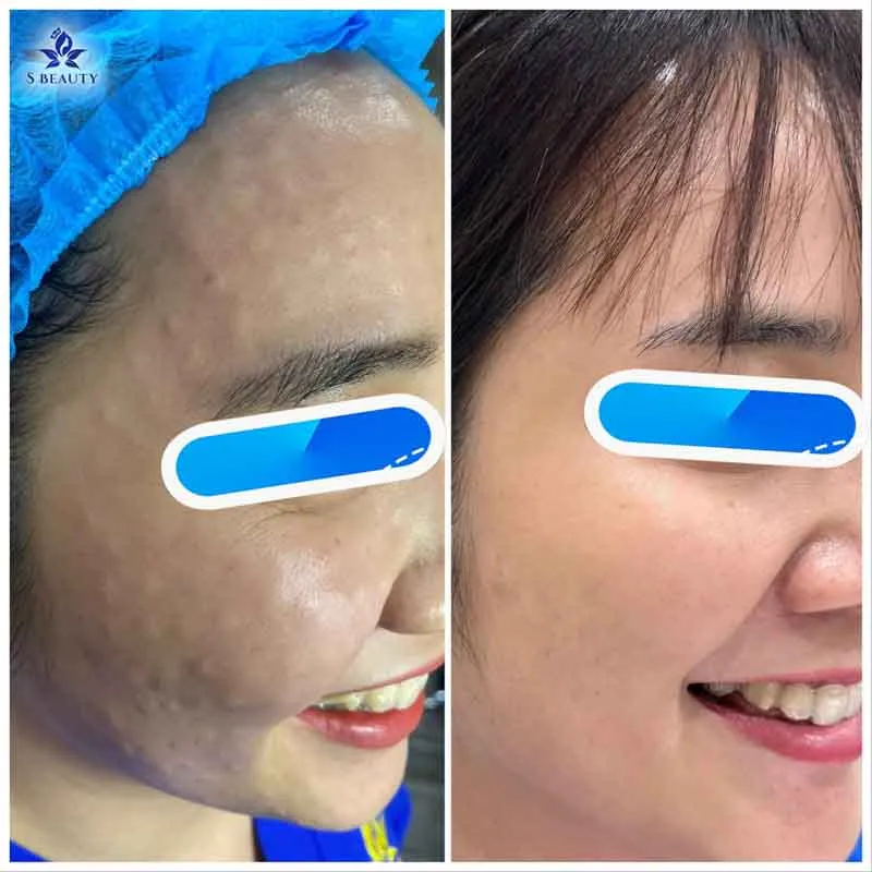 [Phân biệt] Tiêm meso và filler khác nhau như thế nào?