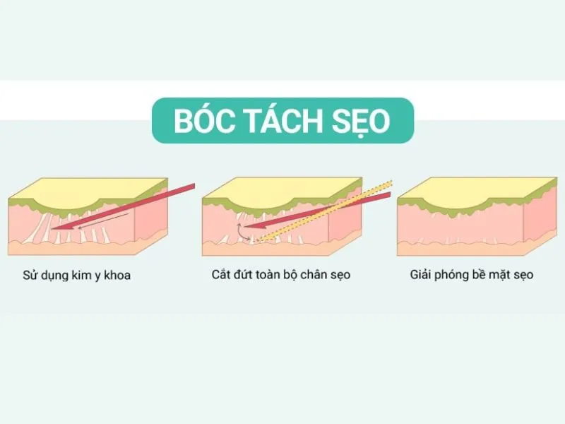 Phương pháp cắt đáy sẹo là gì? Ưu và nhược điểm của cắt đáy sẹo