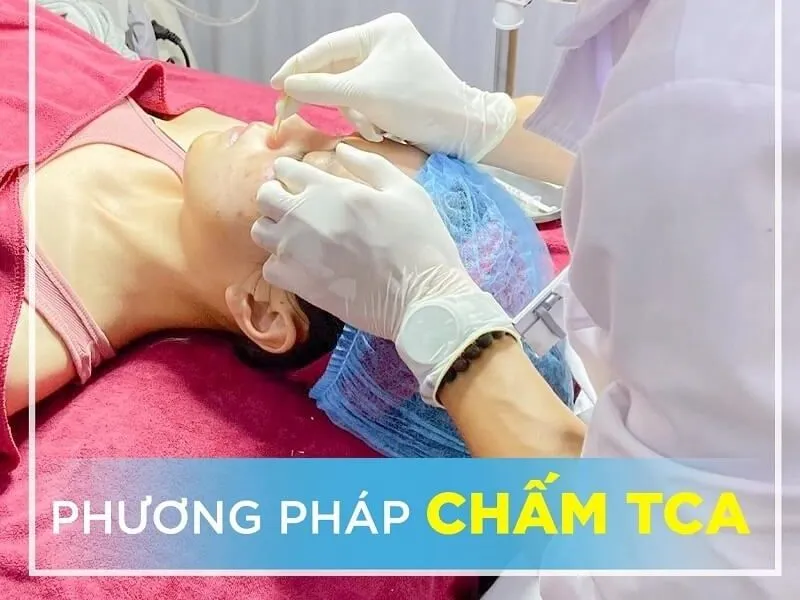 Sẹo rỗ đáy nhọn là gì? Nguyên nhân và các phương pháp điều trị