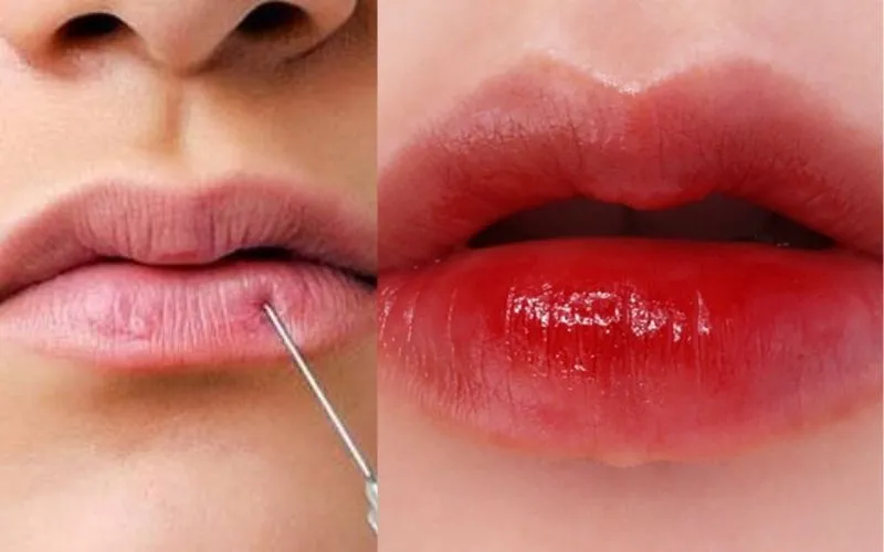 Tiêm filler môi bị nổi mụn là do đâu? Cách khắc phục ra sao?