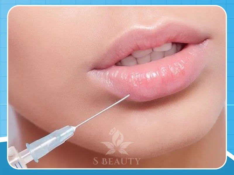 Tiêm Filler môi dáng đẹp hot nhất hiện nay với chi phí cực thấp