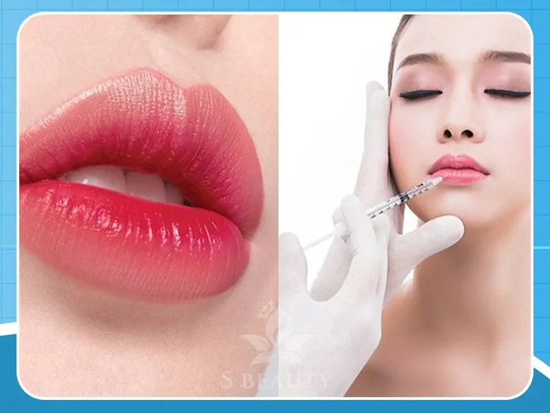 Tiêm Filler môi dáng đẹp hot nhất hiện nay với chi phí cực thấp