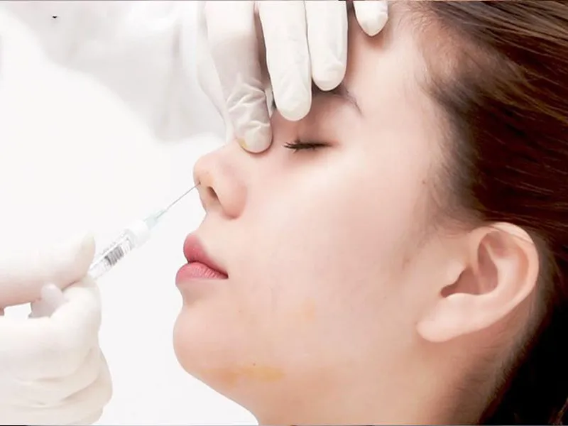 Tiêm filler mũi có được nặn mụn không? Lưu ý sau khi tiêm filler