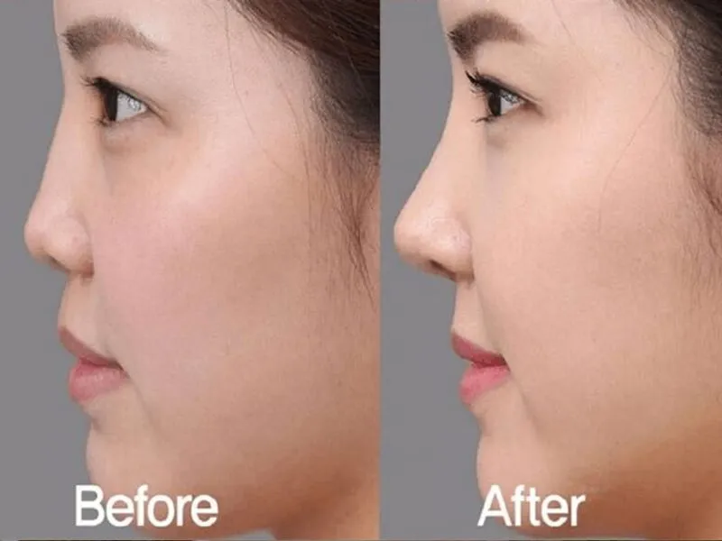 Tiêm filler mũi có được nặn mụn không? Lưu ý sau khi tiêm filler