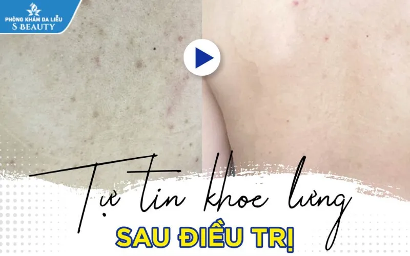 Top 5 spa trị mụn lưng an toàn dứt điểm chỉ sau một liệu trình